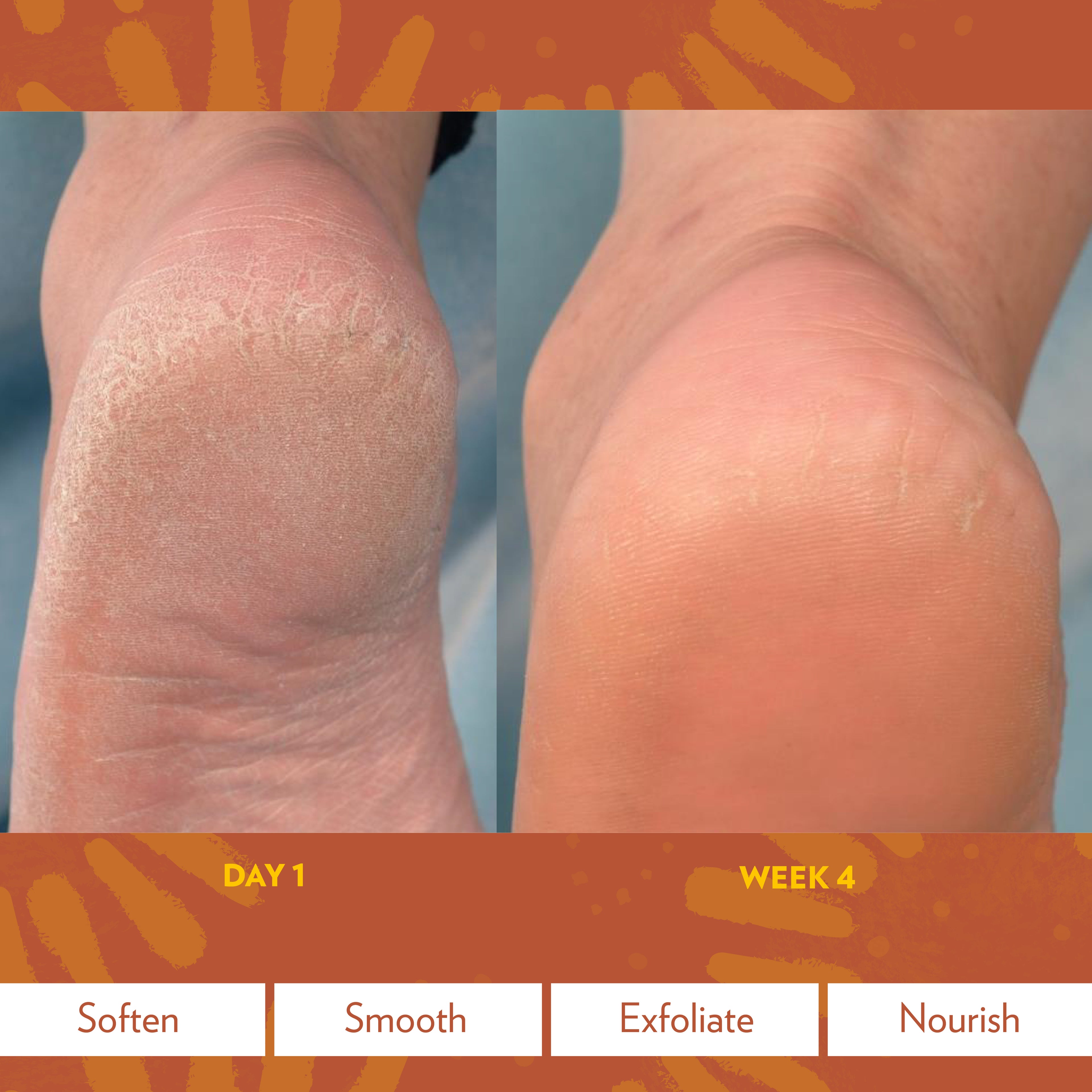 Epoch® Sole Solution® Foot Treatment