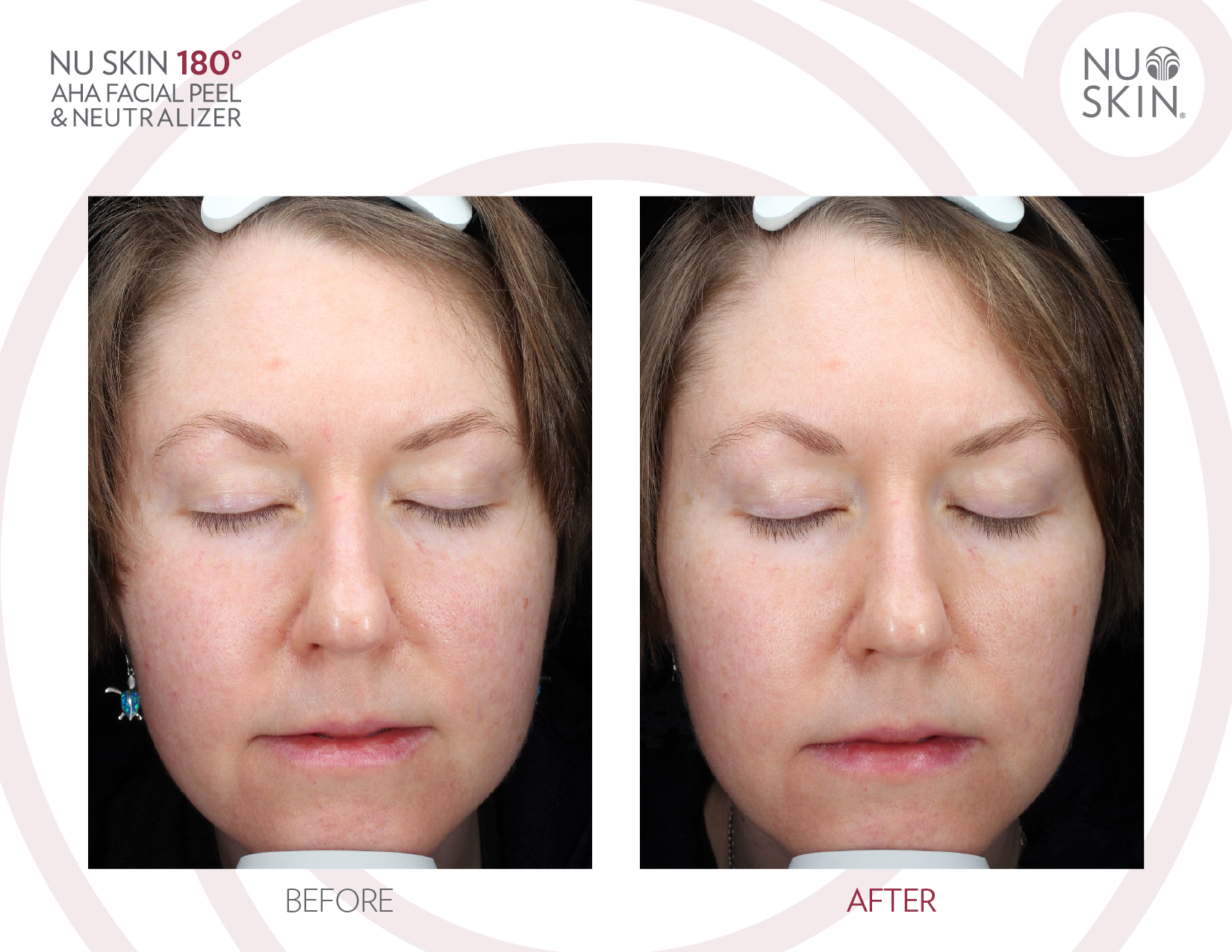 180°® AHA Facial Peel and Neutralizer