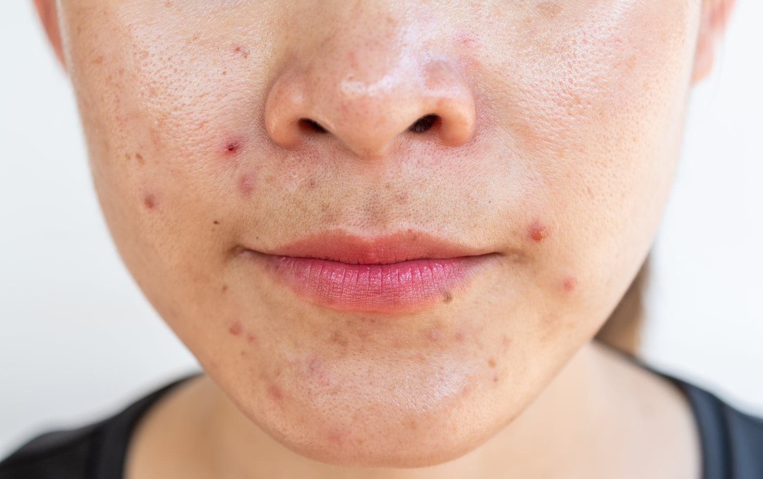 Acne Skin