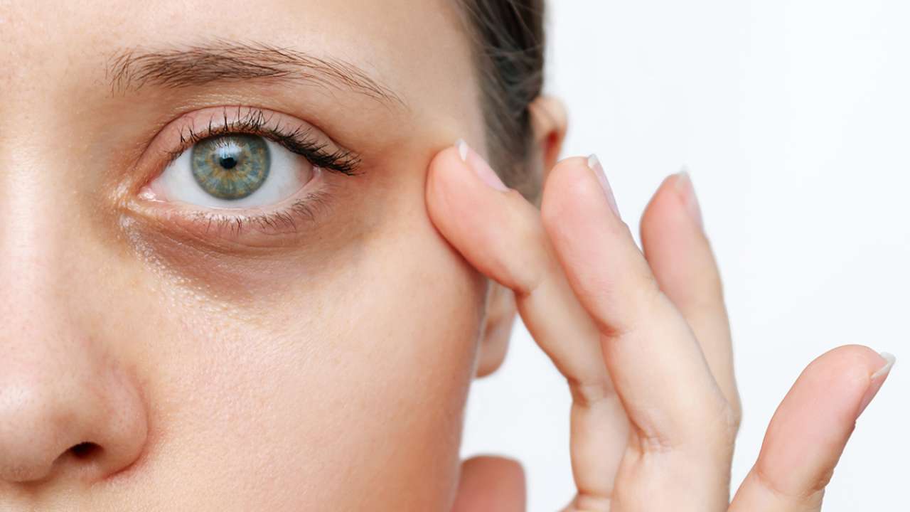 Dark Circles &amp; Puffiness