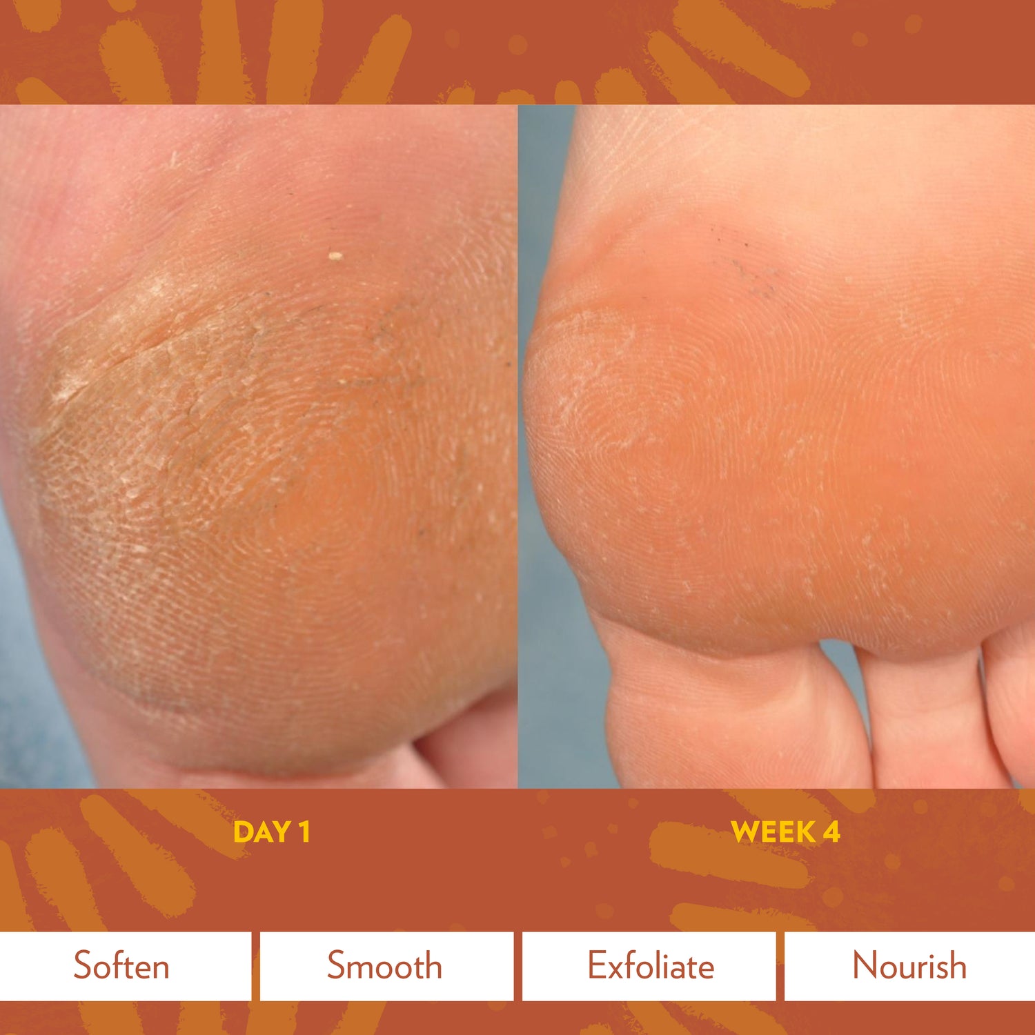 Epoch® Sole Solution® Foot Treatment