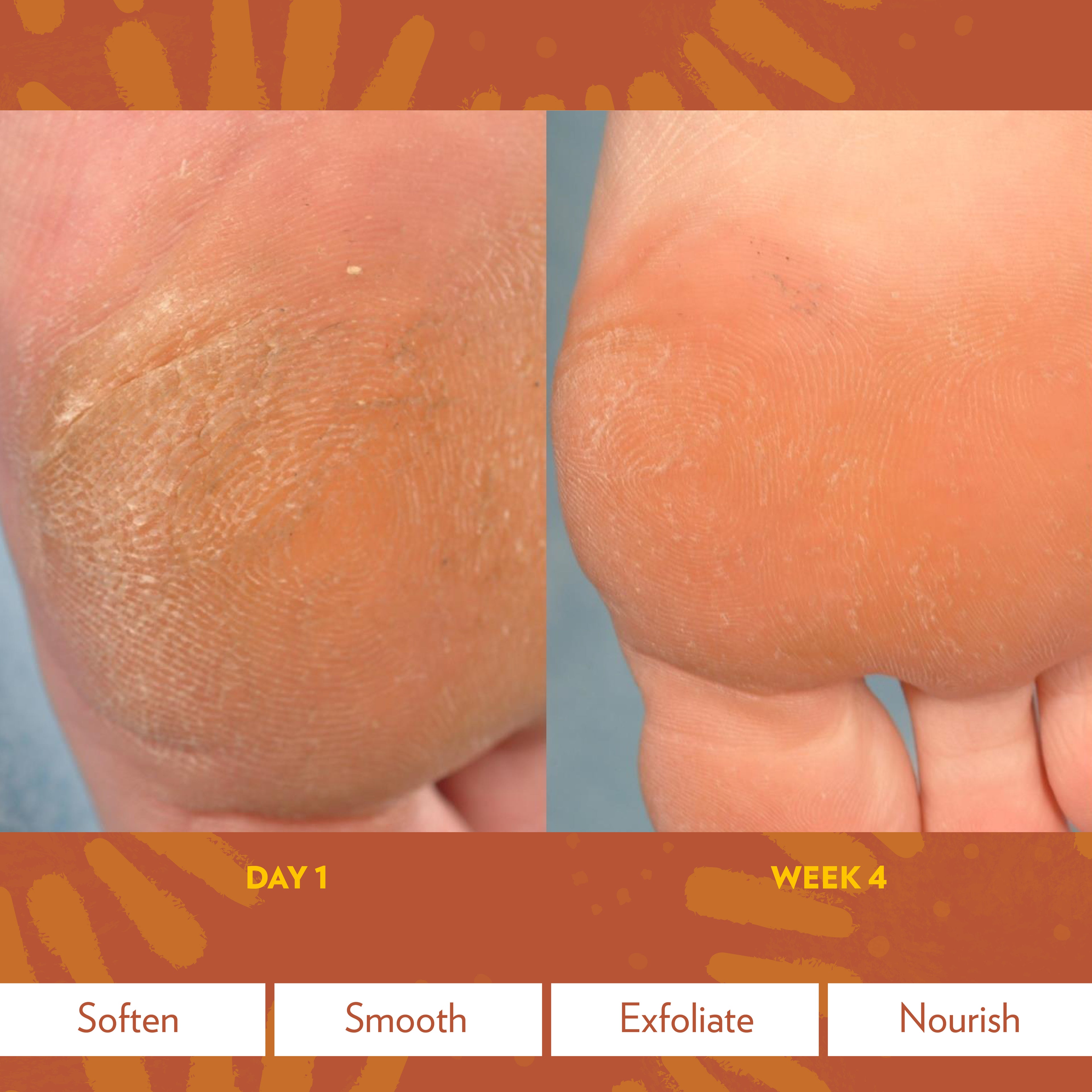 Epoch® Sole Solution® Foot Treatment