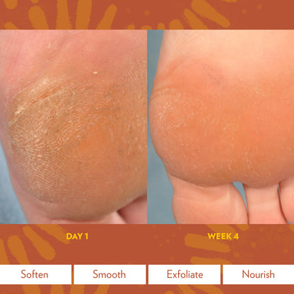 Epoch® Sole Solution® Foot Treatment